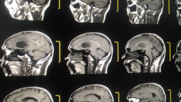 Plant-Based Nanoparticle Therapy Targets Glioblastoma with Precision